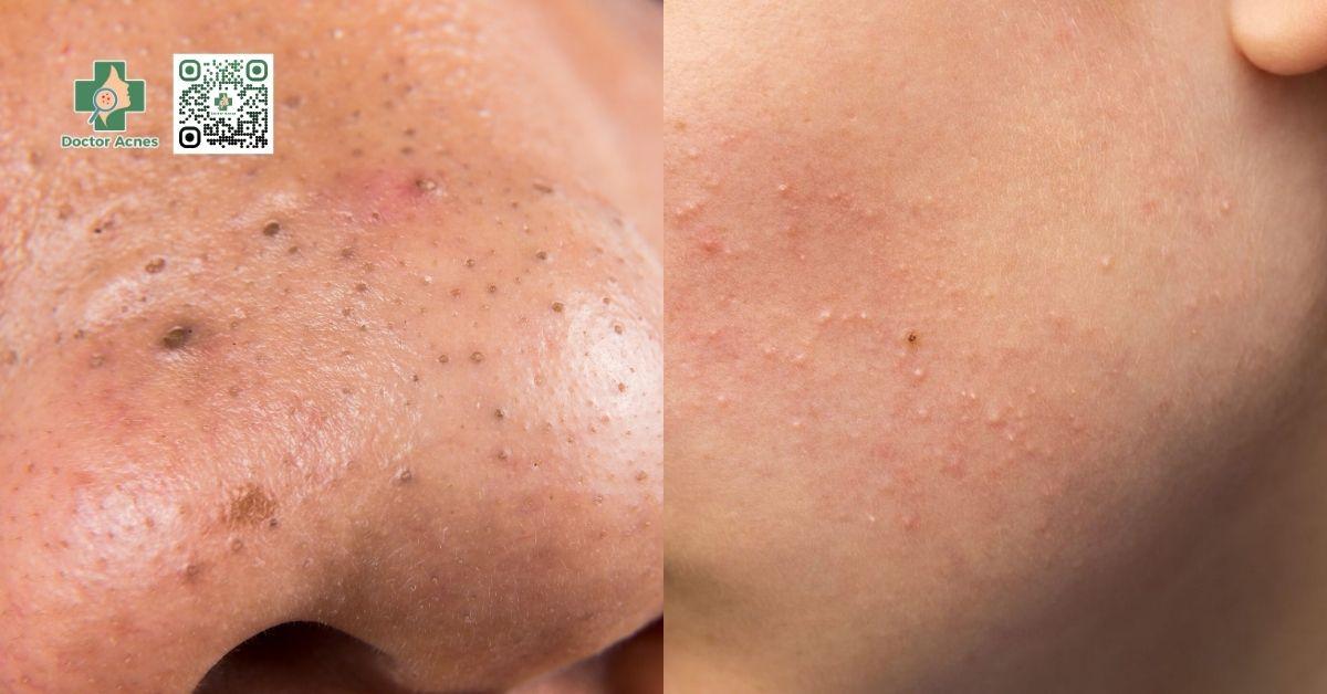 Các loại mụn li ti thường gặp và cách xử lý tốt nhất