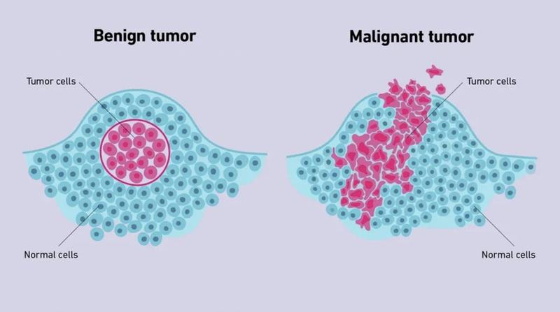 Khối u lành tính có chuyển thành ác tính không? Một số loại u lành tính thường gặp