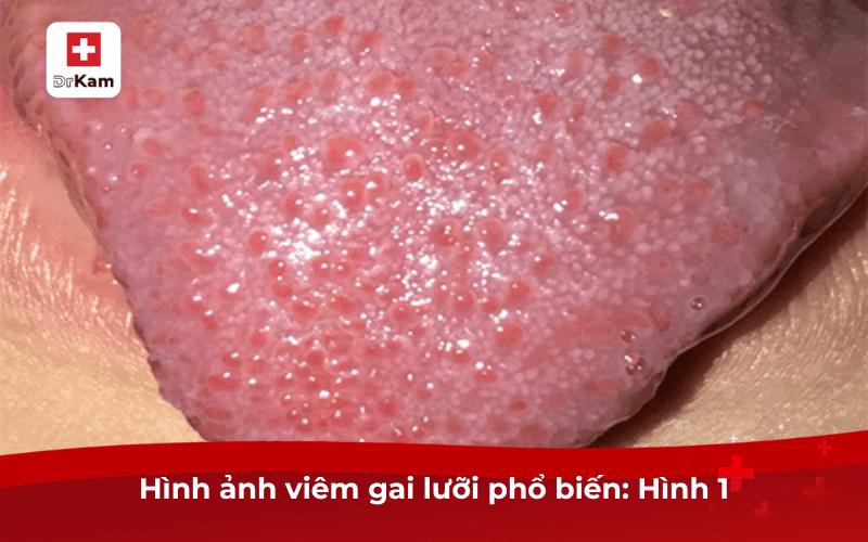 Thực tế hình ảnh viêm gai lưỡi: 10 Nguyên nhân và cảnh báo nguy hiểm điều trị ngay