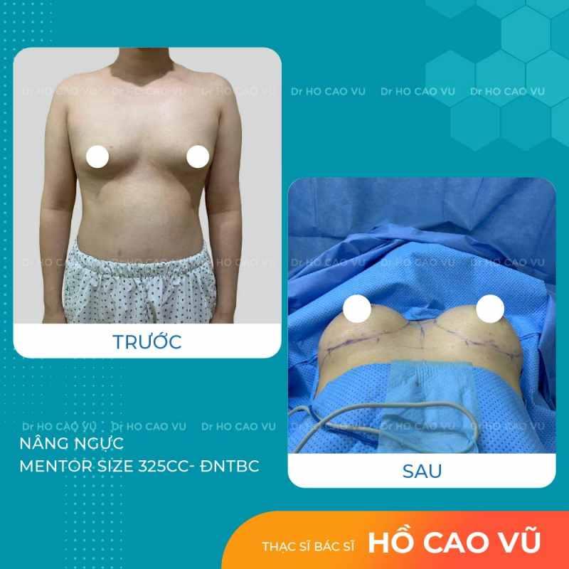 Hình ảnh nâng ngực size 325cc cho chị khách 9X sau 2 năm