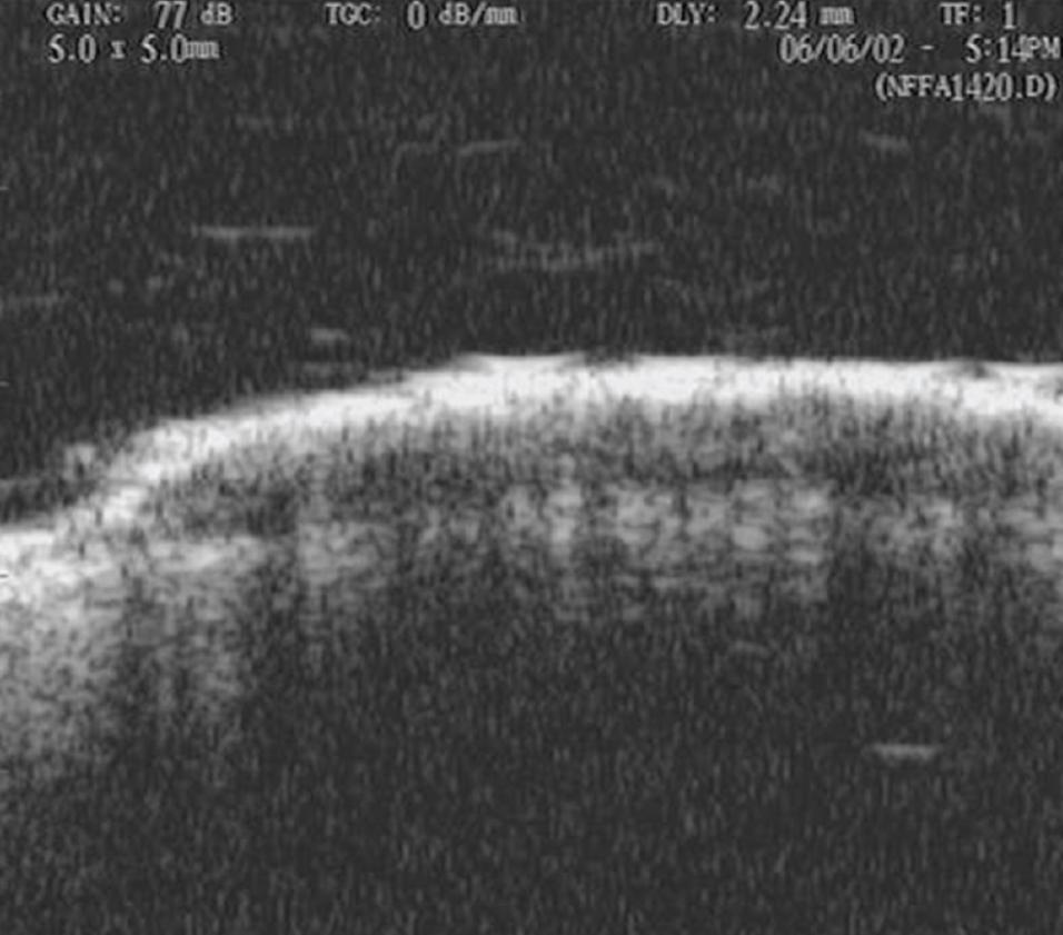 Ứng dụng của Siêu âm trong các khối u da