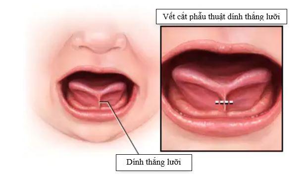 Kiến thức Y khoa | Tình trạng Dính Thắng Lưỡi Và “Bú Kém”, “Chậm Nói”, “Nói Ngọng” ở trẻ